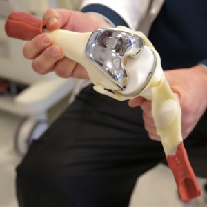 Hip replacements, other orthopedic devices not properly tracked by VA